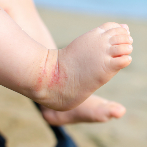 atopic dermatitis newborn feet eczema