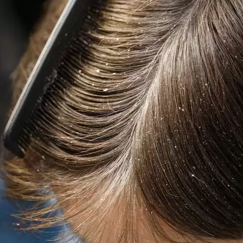 dandruff on the head of dark-haired guy