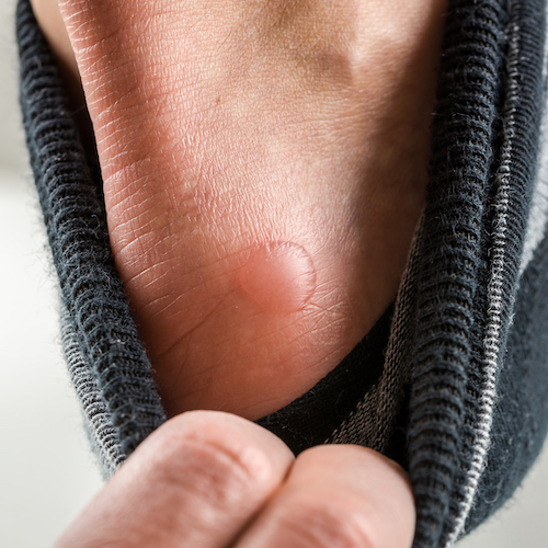 Man with a fluid blister on his heel