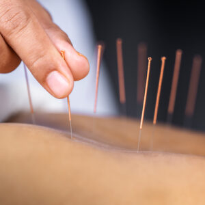  acupuncture